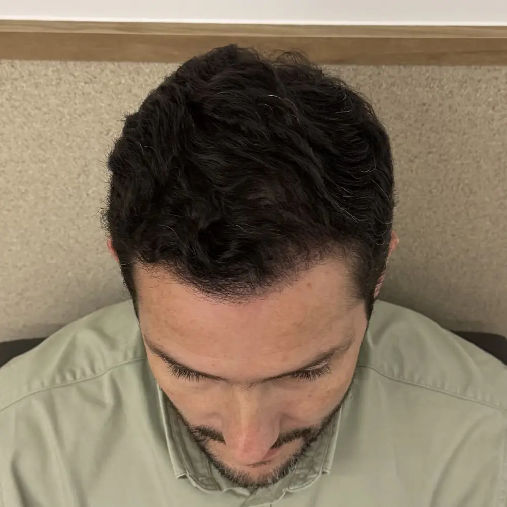 Imagem depois — Depois