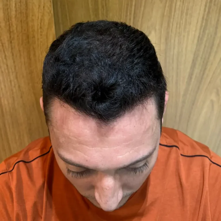 Imagem depois — Depois