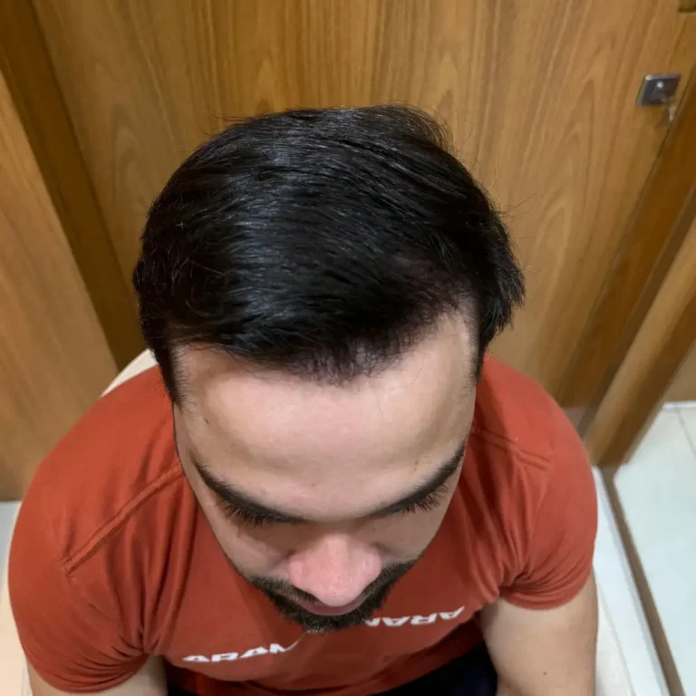 Imagem depois — Depois
