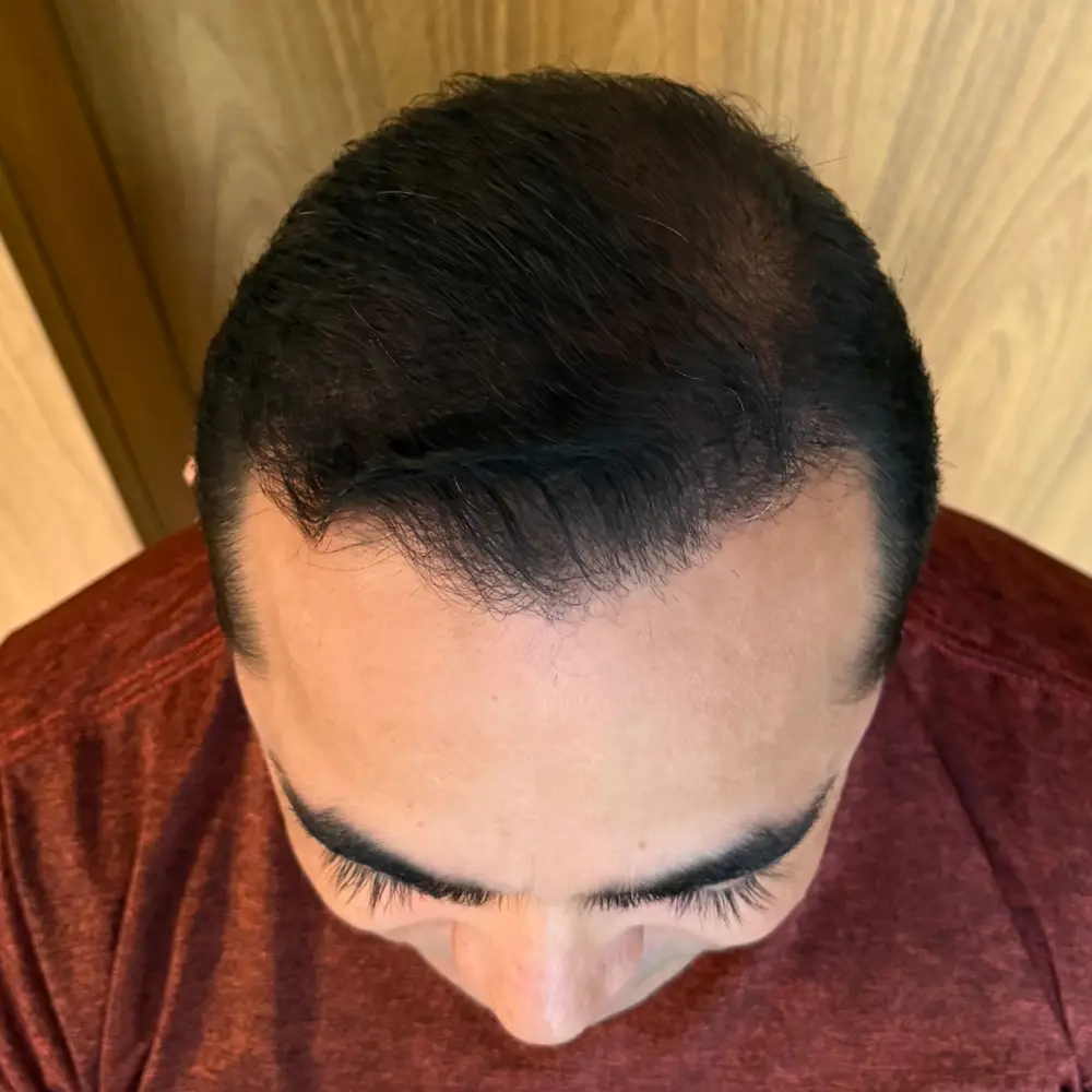 Paciente após transplante capilar com resultado natural